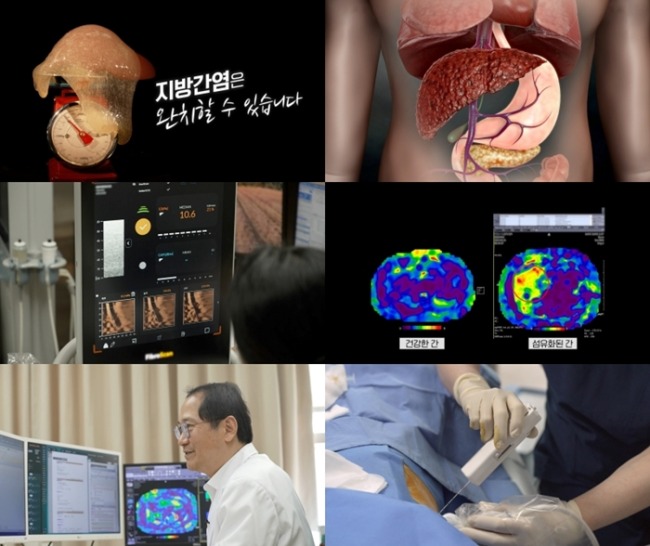 명의 967회 서서히 굳어간다? 간이 보내는 마지막 SOS… 지방간염의 습격